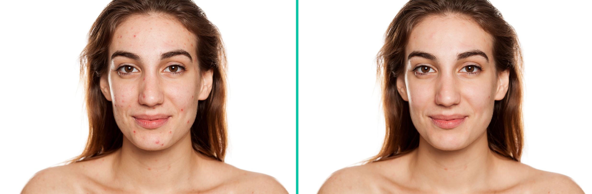 Side-by-side photos of a woman: left shows her with acne and blemishes, right showcases the results of AI Blemish Removal, revealing clear, smooth skin. Both images have a white background and she faces the camera with a neutral expression.