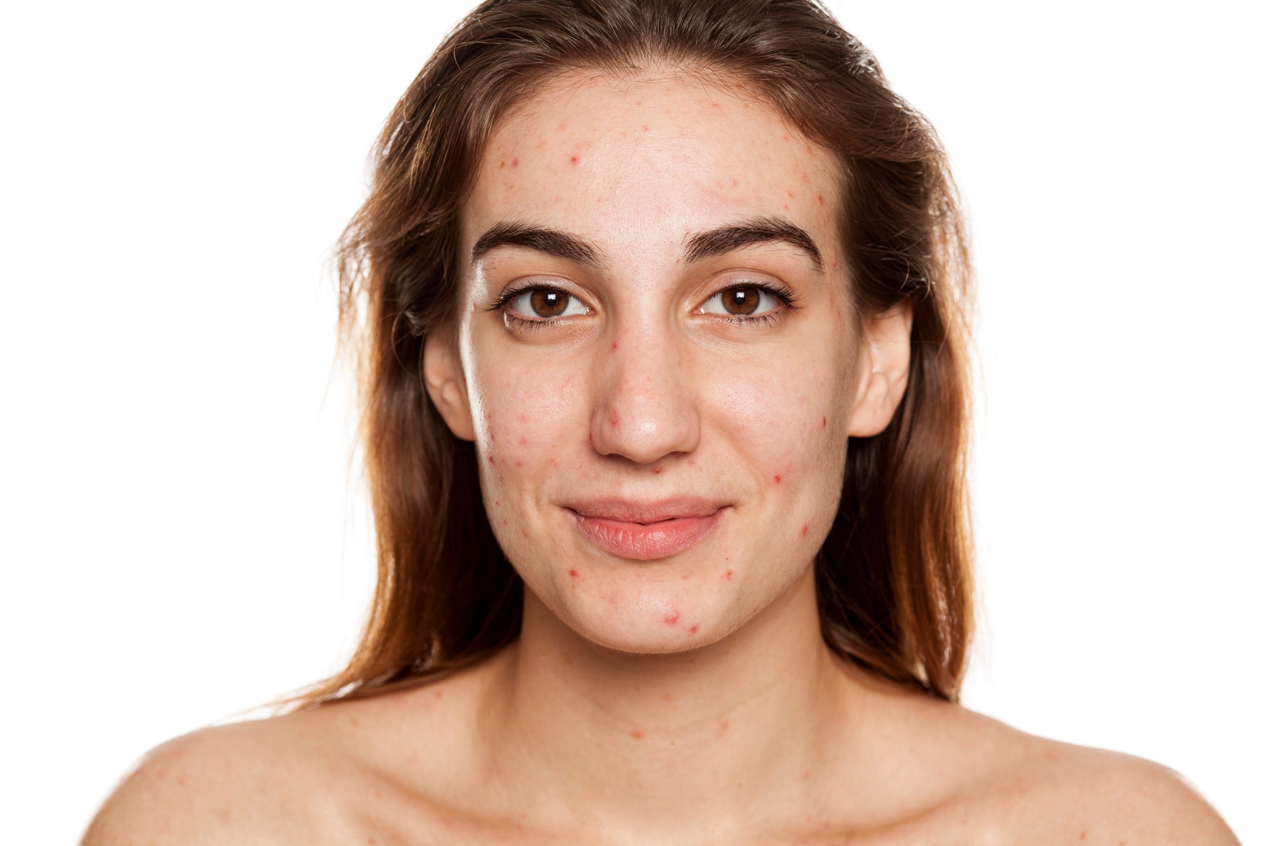 Young woman with long brown hair and bare shoulders, facing forward and smiling slightly. She has visible acne and blemishes on her cheeks, chin, and forehead—perfect for showcasing the natural look before AI Blemish Removal. The background is plain white.